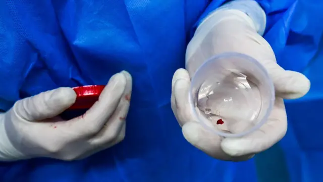 Mãos de um profissional da saúde, com luvas de plástico, seguram um pote com um pequeno tumor avermelhado