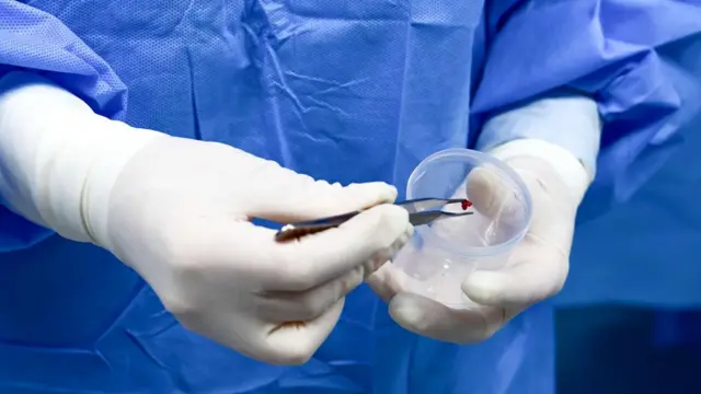 Médico segura tumor com uma pinça antes de colocá-lo num pote de plástico